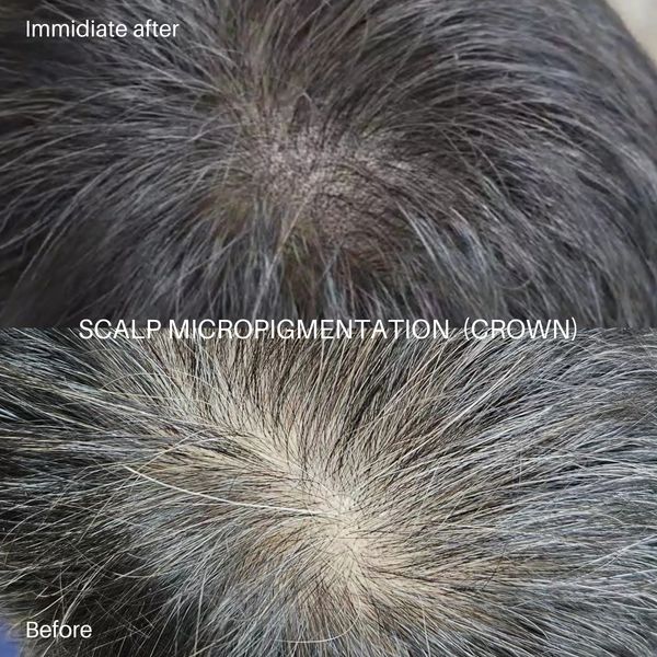 SCALP MICROPIGMENTATION